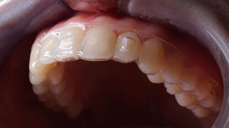 Зубнал элайнеры для выравнивания зубов