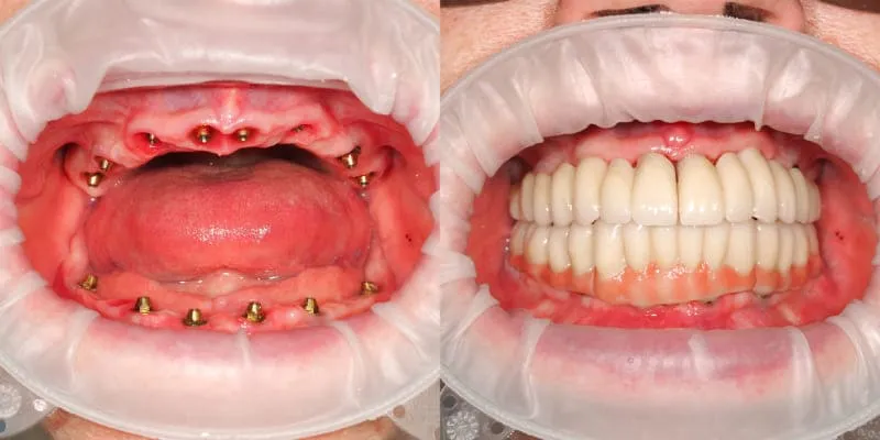 Зубнал имплантация без травматизма
