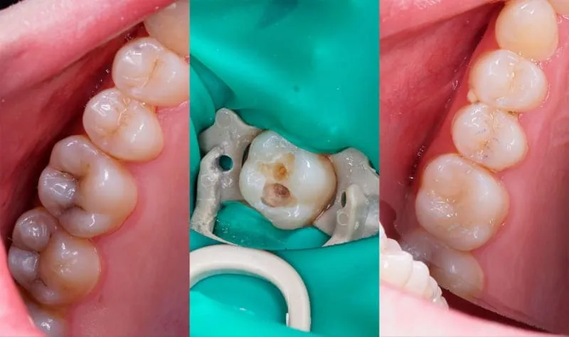 Зубнал лечение кариеса без боли