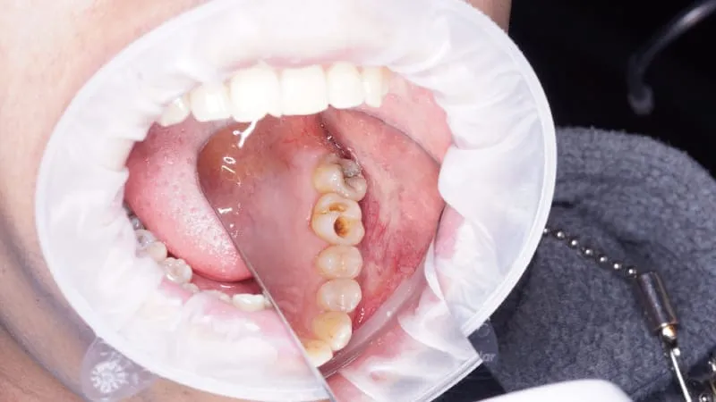 Зубнал лечение кариеса ДО
