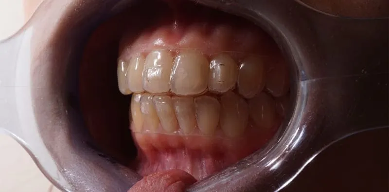 Зубнал лечение с помощью элайнеров