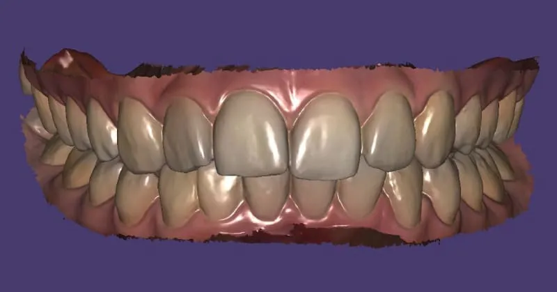 Зубнал протезирование зубов 3D сканирование