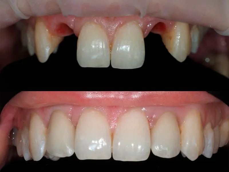 Зубнал протезирование зубов недорого